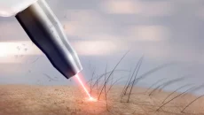 Laser Treatments